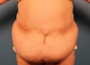 Case--4990 | Before Abdominoplasty 1