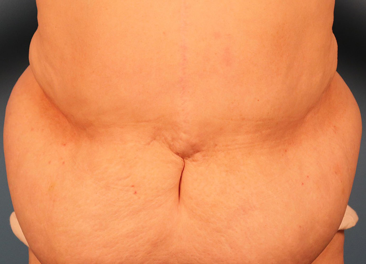 Case--4990 | Before Abdominoplasty