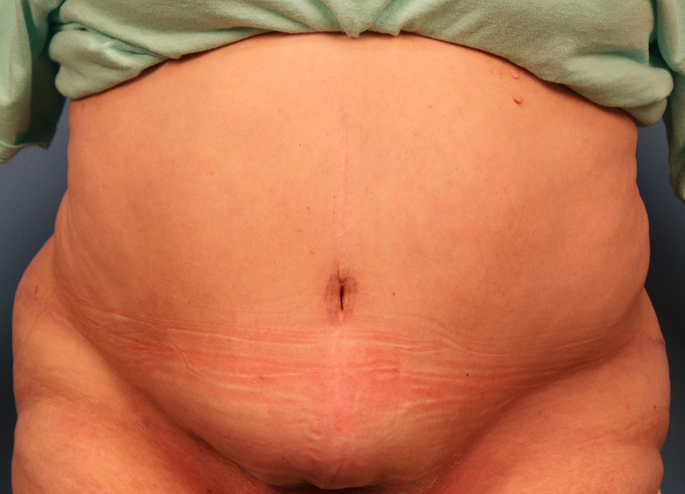 Case--4990 | After Body