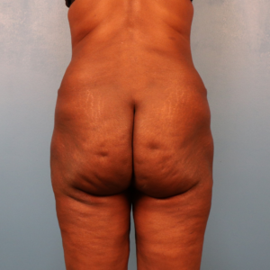 Postoperative view of a female patient after hip and thigh liposuction showing improved contour of the hips, inner thighs, and outer thighs at a plastic surgery practice in Montgomery, Alabama.