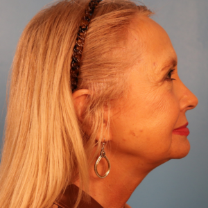 Side-view postoperative photo of a female patient after facelift surgery showing improved jawline definition, reduced jowling, and enhanced facial contour at a plastic surgery practice in Montgomery, Alabama.