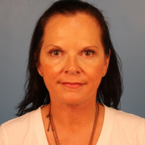 Frontal postoperative view of a female patient after facelift surgery showing improved facial contour, enhanced jawline definition, and reduced facial laxity at a plastic surgery practice in Montgomery, Alabama.