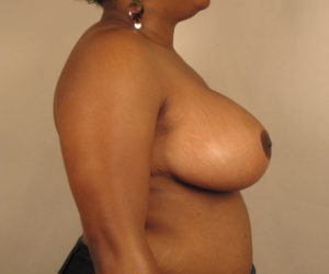 Right profile after breast reduction with mastopexy by Dr. Bentley in Montgomery, AL.