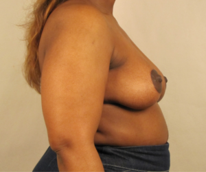 Right side view after breast reduction and lift surgery by Dr. Bentley in Montgomery, AL.