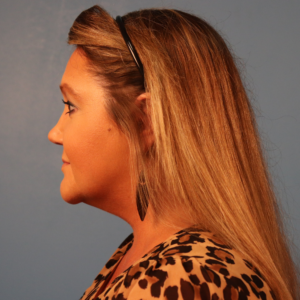 Side-view postoperative photo of a patient after submental liposuction showing improved jawline definition and reduced fullness beneath the chin at a plastic surgery practice in Montgomery, Alabama.