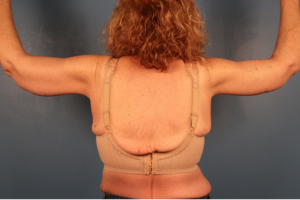 Back view after brachioplasty (arm lift) by Dr. Bentley in Montgomery, AL.