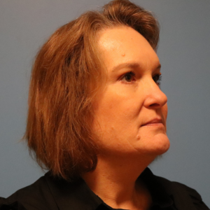 Right three-quarter view after endoscopic brow lift with upper and lower blepharoplasty by Dr. Bentley in Montgomery, AL.