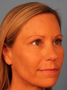 Right quarter-view after photo of a female patient following upper blepharoplasty by Dr. Robertson in Montgomery, Alabama, showing a smoother upper eyelid contour and a naturally refreshed appearance.