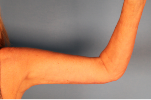 Case--20338 | After Arm Lift (Brachioplasty) 2