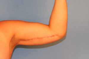 Case--58570 | After Arm Lift (Brachioplasty) 2