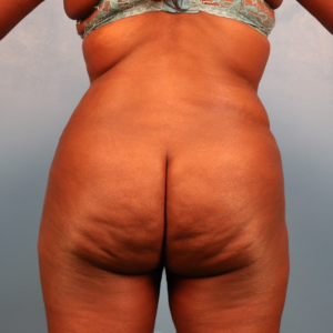 Postoperative view of a female patient after liposuction of the hips and thighs showing improved contour of the inner thighs, outer thighs, and hip area at a plastic surgery practice in Montgomery, Alabama.