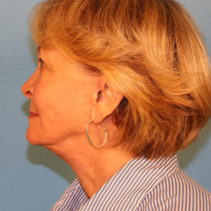 Side-view postoperative photo of a female patient after facelift surgery showing a more defined jawline, smoother facial contour, and reduced jowling at a plastic surgery practice in Montgomery, Alabama.