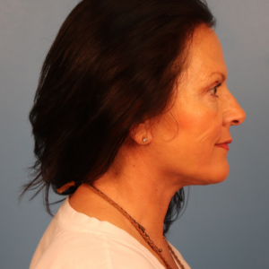 Side-view postoperative photo of a female patient after facelift surgery showing improved jawline contour, smoother facial lines, and reduced jowling at a plastic surgery practice in Montgomery, Alabama.