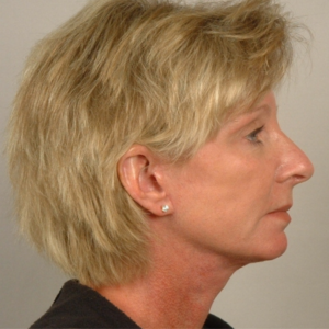 Right side view after facelift, endoscopic brow lift, and upper and lower blepharoplasty by Dr. Bentley in Montgomery, AL.