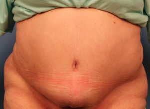 After tummy tuck patient showing a flatter, more contoured abdomen following abdominoplasty by Dr. Bentley in Montgomery, AL.