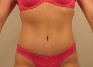 After tummy tuck surgery with improved abdominal contour and tighter midsection by Dr. Bentley in Montgomery, AL.