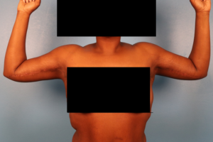 Front view after arm lift surgery (brachioplasty) by Dr. Bentley in Montgomery, AL.