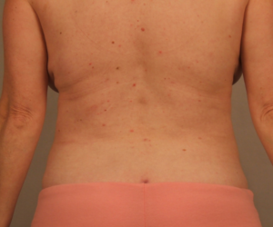 Back view after liposuction of the flanks and sacroiliac crest by Dr. Bentley in Montgomery, AL.