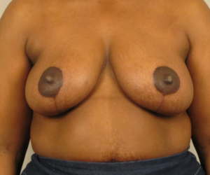 Front view after breast reduction and lift surgery by Dr. Bentley in Montgomery, AL.