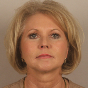 Front view after upper and lower blepharoplasty by Dr. Bentley in Montgomery, AL.