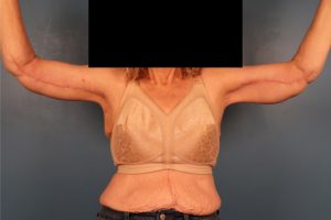 Front view after brachioplasty (arm lift) by Dr. Bentley in Montgomery, AL.