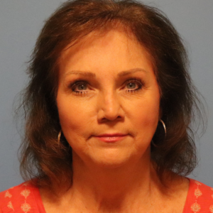 Front view after endoscopic brow lift and upper and lower blepharoplasty by Dr. Bentley in Montgomery, AL.