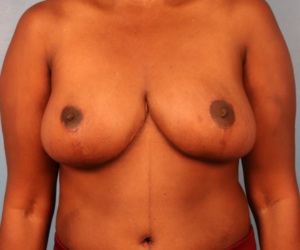 Front view after breast reduction with lift by Dr. Bentley in Montgomery, AL.