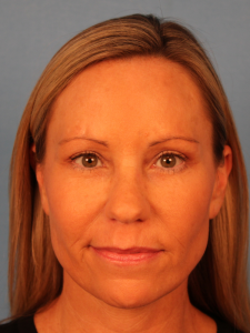 After photo of a female patient following upper blepharoplasty by Dr. Robertson in Montgomery, Alabama, showing smoother upper eyelids and a brighter, more refreshed appearance.
