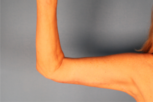 Case--20338 | After Arm Lift (Brachioplasty) 1