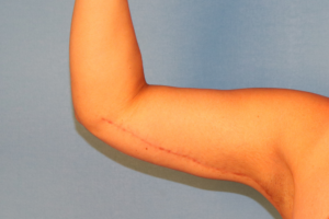 Case--58570 | After Arm Lift (Brachioplasty) 1