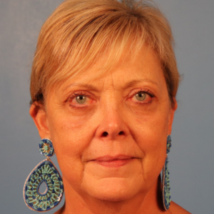 Postoperative frontal view of a patient after upper blepharoplasty and transconjunctival lower blepharoplasty showing improved eyelid contour, reduced under-eye fullness, and a more refreshed appearance at a plastic surgery practice in Montgomery, Alabama.