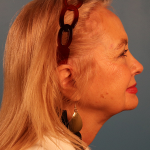 Side-view preoperative photo of a female patient before facelift surgery showing facial skin laxity, jowling, and loss of jawline definition at a plastic surgery practice in Montgomery, Alabama.