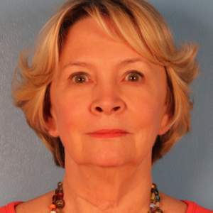 Frontal preoperative view of a female patient before facelift surgery showing age-related facial laxity, jowling, and softening of the jawline at a plastic surgery practice in Montgomery, Alabama.