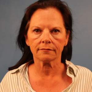 Frontal preoperative view of a female patient before facelift surgery showing facial sagging, jowl formation, and loss of contour in the lower face at a plastic surgery practice in Montgomery, Alabama.