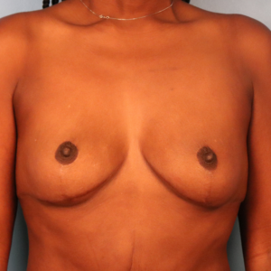 Frontal preoperative view of a female patient before breast augmentation showing natural breast size and shape at a plastic surgery practice in Montgomery, Alabama.
