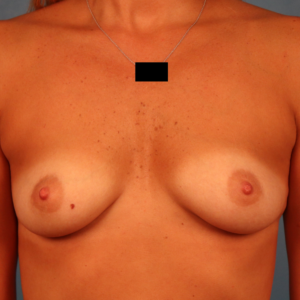 Frontal preoperative view of a female patient before breast augmentation showing natural breast shape and volume at a plastic surgery practice in Montgomery, Alabama.