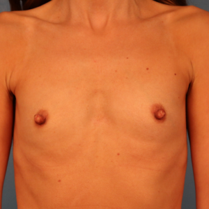 Frontal preoperative view of a female patient before breast augmentation surgery showing natural breast contours and breast volume at a plastic surgery practice in Montgomery, Alabama.