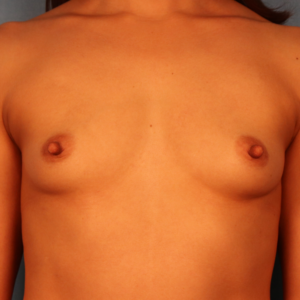 Frontal preoperative view of a female patient before breast augmentation showing natural breast size, shape, and contour at a plastic surgery practice in Montgomery, Alabama.