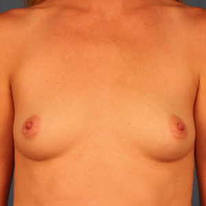 Before breast augmentation patient of Dr. Budny in Montgomery, Alabama. Front-view pre-operative photo showing natural breast shape prior to breast implant surgery.
