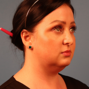 Right three-quarter view before neck contouring surgery by Dr. Bentley in Montgomery, AL.