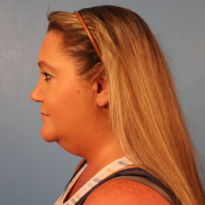 Side-view preoperative photo of a patient before submental liposuction showing fullness beneath the chin and along the upper neck at a plastic surgery practice in Montgomery, Alabama.