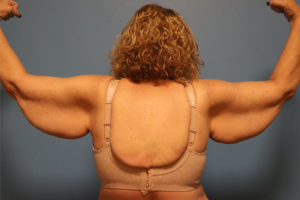 Back view before brachioplasty (arm lift) by Dr. Bentley in Montgomery, AL.