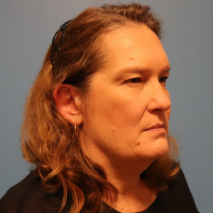 Right three-quarter view before endoscopic brow lift with upper and lower blepharoplasty by Dr. Bentley in Montgomery, AL.