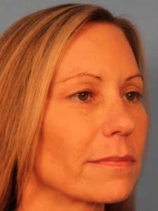 Right quarter-view before photo of a female patient prior to upper blepharoplasty by Dr. Robertson in Montgomery, Alabama, showing excess upper eyelid skin and a hooded eyelid appearance.