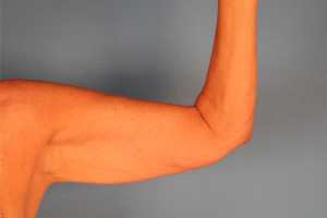 Case--20338 | Before Arm Lift (Brachioplasty) 2