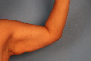 Case--58570 | Before Arm Lift (Brachioplasty) 2
