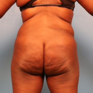 Preoperative view of a female patient before liposuction of the hips and thighs showing excess fat in the inner thighs, outer thighs, and hip area at a plastic surgery practice in Montgomery, Alabama.