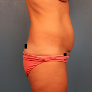 Side-view preoperative photo of a female patient before a mini tummy tuck showing excess lower abdominal skin and abdominal fullness below the belly button at a plastic surgery practice in Montgomery, Alabama.