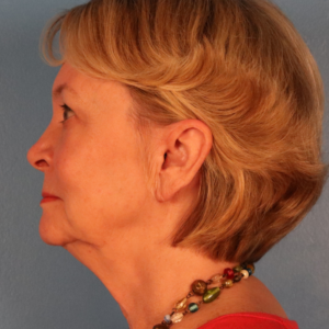 Side-view preoperative photo of a female patient before facelift surgery showing jowling, facial laxity, and age-related changes along the jawline and lower face at a plastic surgery practice in Montgomery, Alabama.