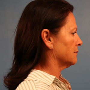 Side-view preoperative photo of a female patient before facelift surgery showing jowls, facial laxity, and loss of jawline definition at a plastic surgery practice in Montgomery, Alabama.